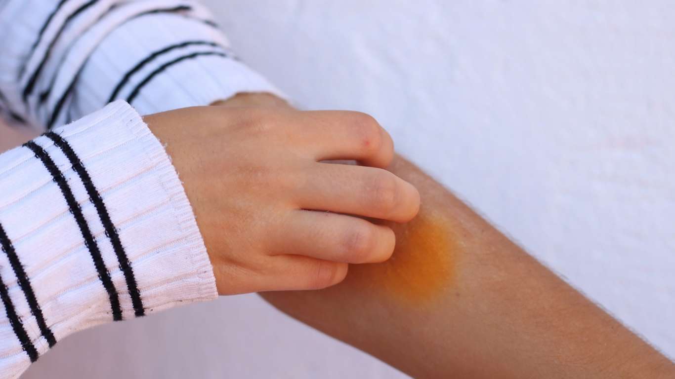 Dermatitis Atópica y Acoso Escolar Cómo Proteger a los Niños en Esta Época de Calor