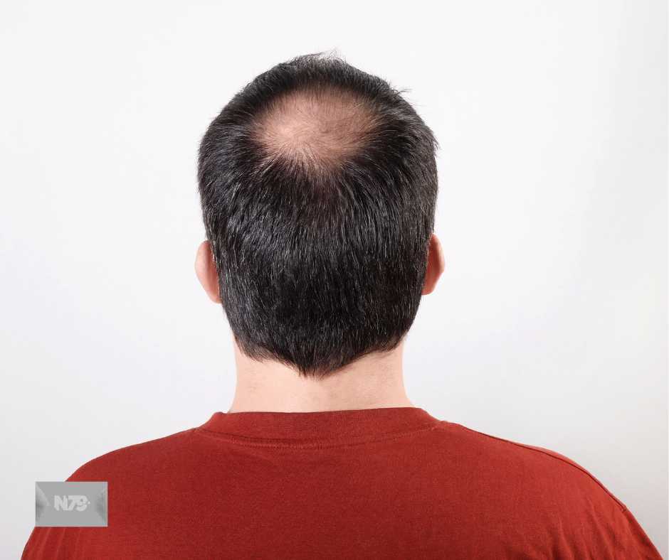 El 40% de la población mexicana sufre de alopecia