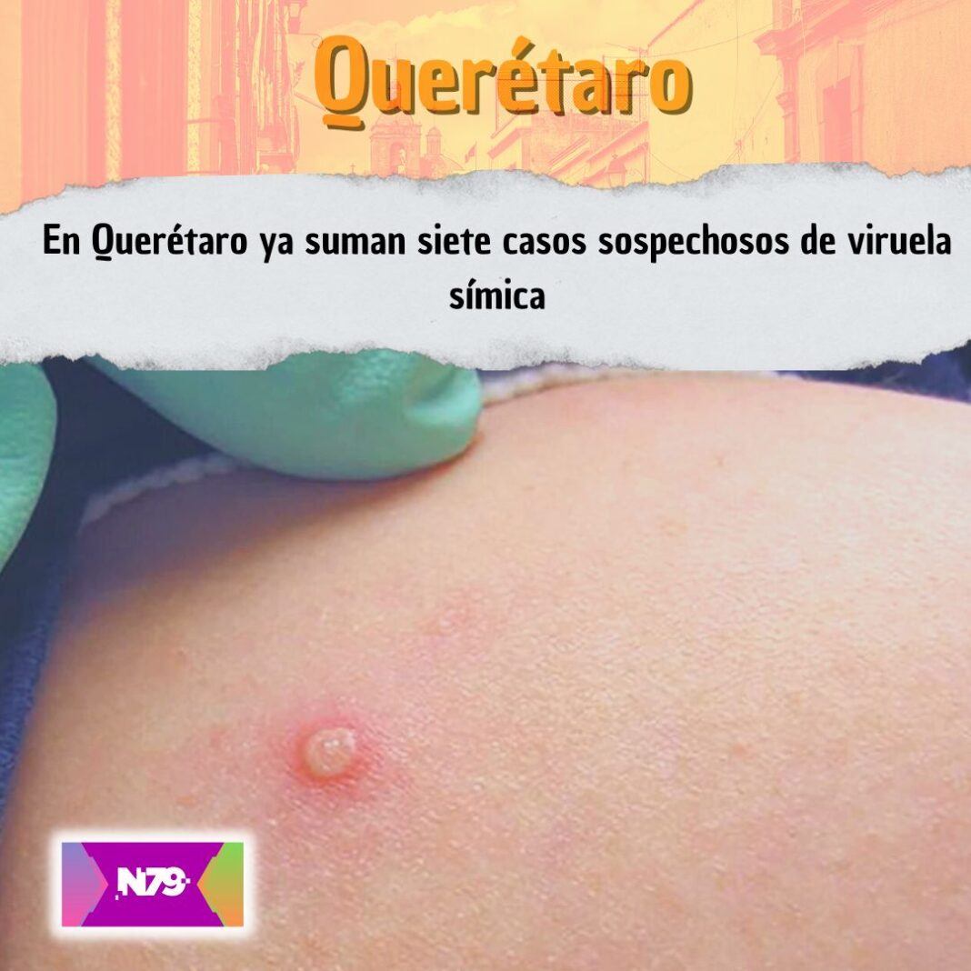 En Querétaro ya suman siete casos sospechosos de viruela símica