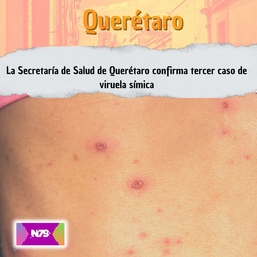 La Secretaría de Salud de Querétaro confirma tercer caso de viruela símica